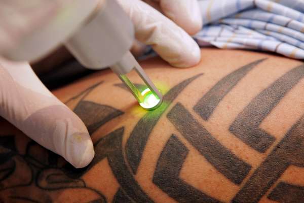 ... Tattoo Removal Services $228 Value from Precision Laser Tattoo Removal